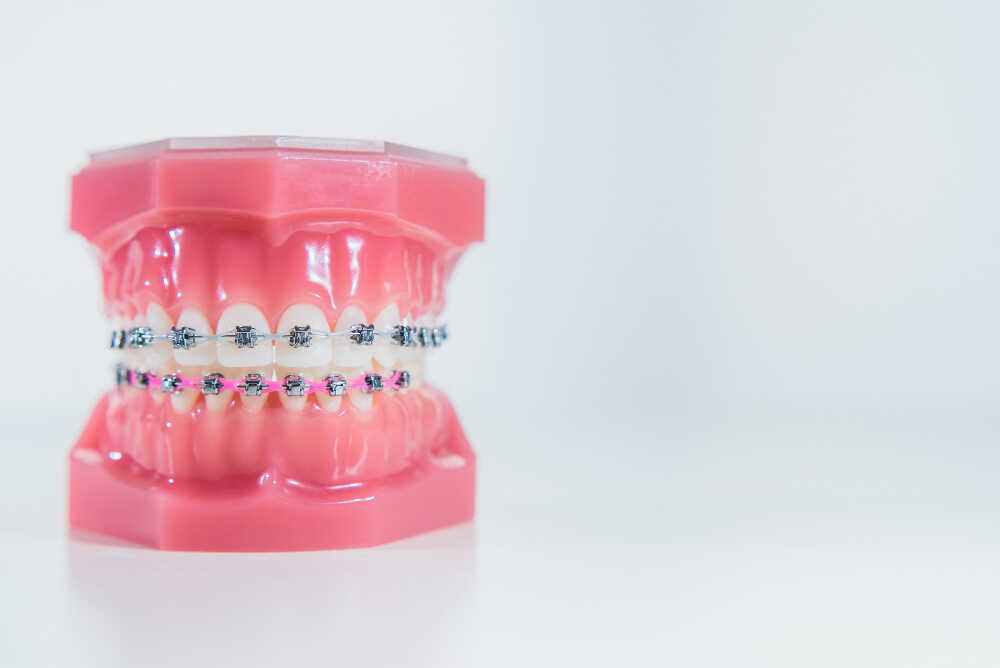 Model aparatu ortodontycznego metalowego